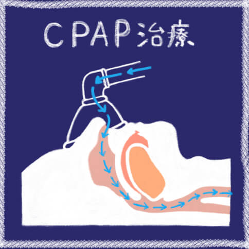 CPAP治療の仕組み