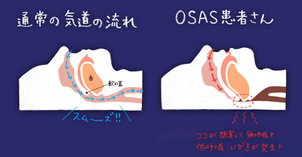 睡眠時無呼吸症候群と健康な人の気道の流れの違い